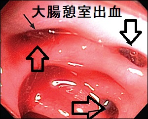 大腸憩室出血 大腸憩室出血
