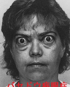 バセドウ病眼症 バセドウ病眼症