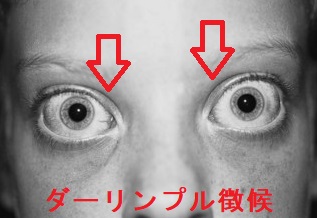 ダーリンプル徴候 ダーリンプル徴候