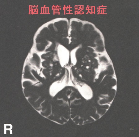 脳血管性認知症 小血管型 脳血管性認知症 小血管型