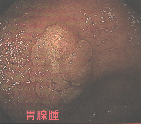 胃腺腫 胃腺腫