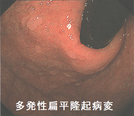 多発性扁平隆起病変 多発性扁平隆起病変