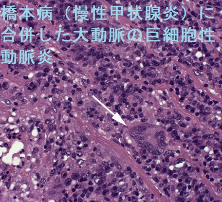 橋本病(慢性甲状腺炎)に合併した大動脈の巨細胞性動脈炎 橋本病(慢性甲状腺炎)に合併した大動脈の巨細胞性動脈炎
