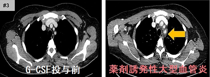 薬剤誘発性大型血管炎 造影CT画像 薬剤誘発性大型血管炎 造影CT画像
