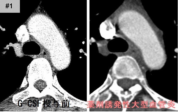 薬剤誘発性大型血管炎 造影CT画像 薬剤誘発性大型血管炎 造影CT画像