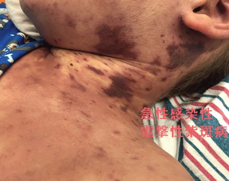 急性感染性電撃性紫斑病 急性感染性電撃性紫斑病