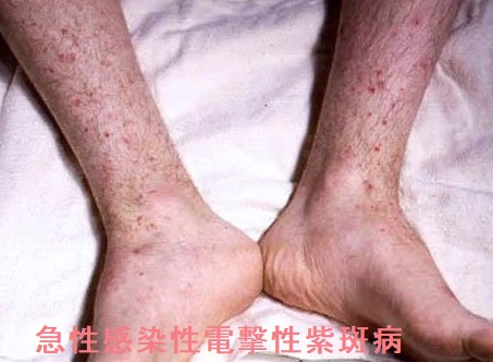 急性感染性電撃性紫斑病 急性感染性電撃性紫斑病