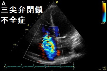 三尖弁閉鎖不全症と甲状腺 三尖弁閉鎖不全症と甲状腺