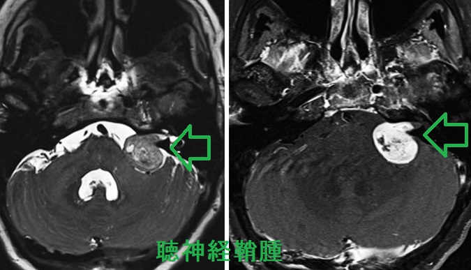 聴神経鞘腫 聴神経鞘腫