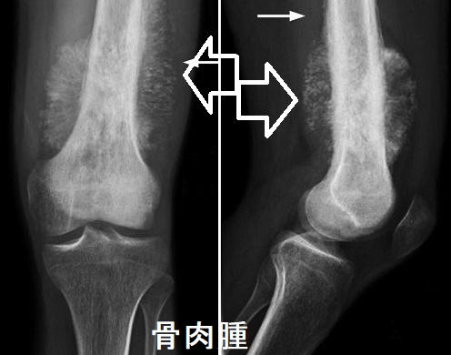 骨肉腫 骨肉腫