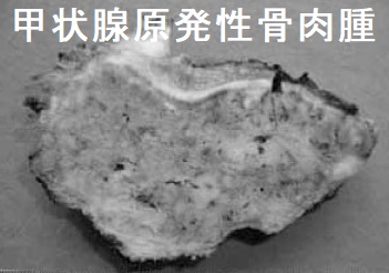 甲状腺原発性骨肉腫 甲状腺原発性骨肉腫