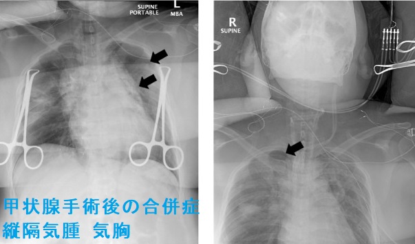 甲状腺手術後の合併症、縦隔気腫 気胸 甲状腺手術後の合併症、縦隔気腫 気胸
