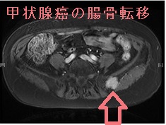 甲状腺癌の腸骨転移 甲状腺癌の腸骨転移
