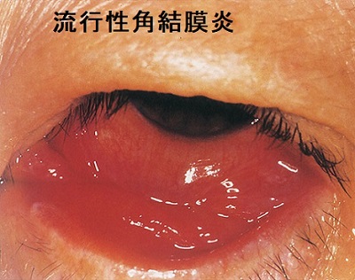 アデノウイルス 流行性角結膜炎 アデノウイルス 流行性角結膜炎