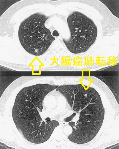 大腸癌肺転移 大腸癌肺転移
