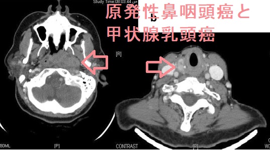 甲状腺と舌(原発性鼻咽頭癌と甲状腺乳頭癌) 甲状腺と舌(原発性鼻咽頭癌と甲状腺乳頭癌)