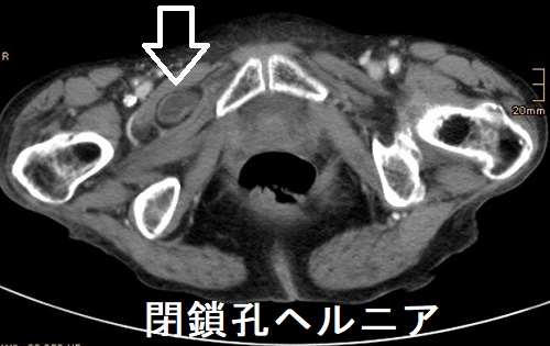 閉鎖孔ヘルニア CT画像 閉鎖孔ヘルニア CT画像