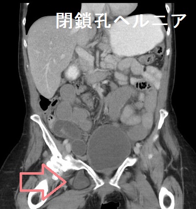 閉鎖孔ヘルニア CT画像 閉鎖孔ヘルニア CT画像