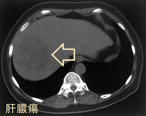 肝膿瘍 単純CT画像 肝膿瘍 単純CT画像