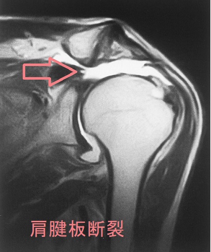 肩腱板断裂 MRI T2強調画像 肩腱板断裂 MRI T2強調画像