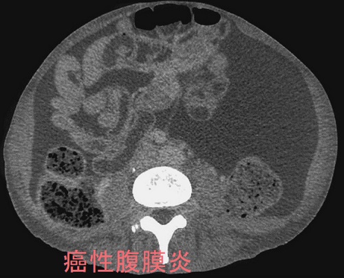 癌性腹膜炎 癌性腹膜炎