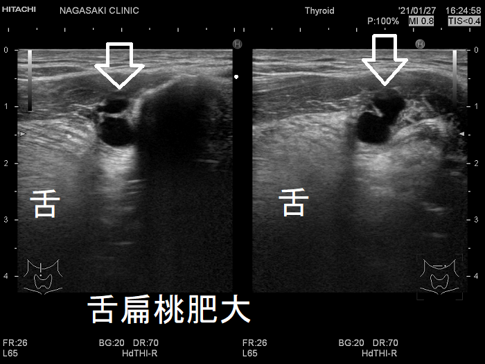 舌扁桃肥大 超音波(エコー)画像 舌扁桃肥大 超音波(エコー)画像
