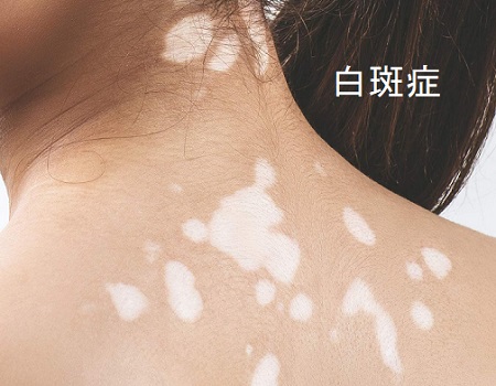 白斑症と甲状腺 白斑症と甲状腺