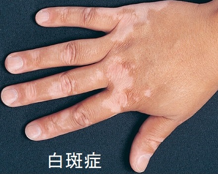 白斑症と甲状腺 白斑症と甲状腺