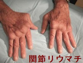 関節リウマチ;両手の関節変形 関節リウマチ;両手の関節変形