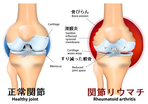 関節リウマチ;関節炎 関節リウマチ;関節炎