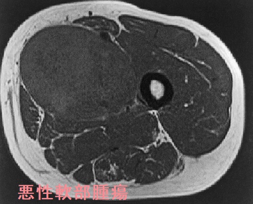 悪性軟部腫瘍 MRI T1画像 悪性軟部腫瘍 MRI T1画像