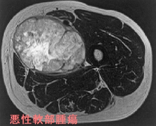 軟部悪性腫瘍(軟部肉腫)に用いるパゾパニブ(ヴォトリエント®)で甲状腺機能障害(破壊性甲状腺炎) 軟部悪性腫瘍(軟部肉腫)に用いるパゾパニブ(ヴォトリエント®)で甲状腺機能障害(破壊性甲状腺炎)