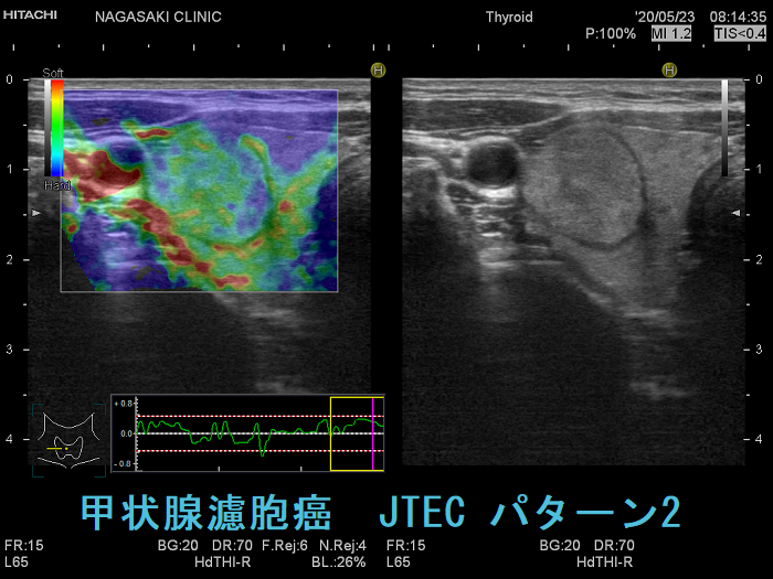 広範浸潤型濾胞癌 (エラストグラフィー JTEC パターン2) 広範浸潤型濾胞癌 (エラストグラフィー JTEC パターン2)