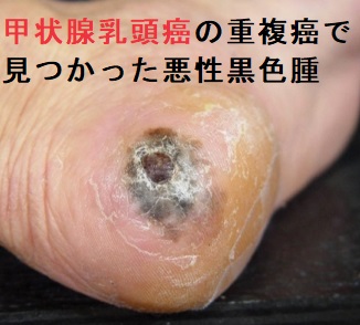 甲状腺と皮膚の異常③悪性腫瘍編[橋本病 バセドウ病 甲状腺