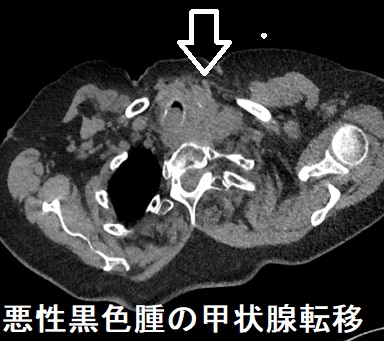 悪性黒色腫の甲状腺転移 CT画像 悪性黒色腫の甲状腺転移 CT画像