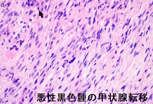 悪性黒色腫の甲状腺転移 組織像 悪性黒色腫の甲状腺転移 組織像