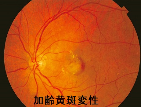 加齢黄斑変性 眼底検査 加齢黄斑変性 眼底検査