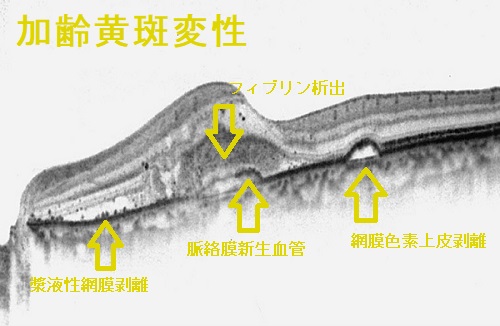 加齢黄斑変性 光干渉断層像(OCT) 加齢黄斑変性 光干渉断層像(OCT)
