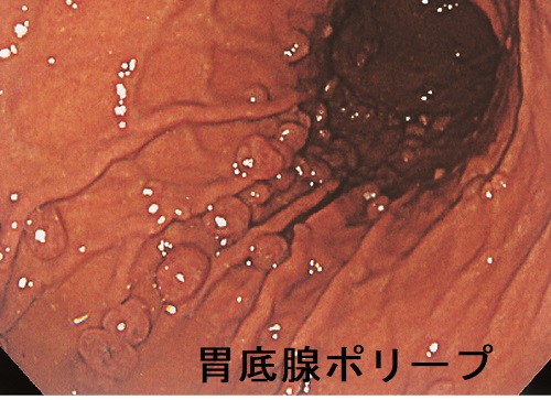 胃底腺ポリープ 胃底腺ポリープ