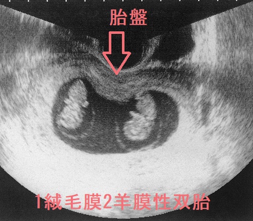 1絨毛膜2羊膜性双胎 1絨毛膜2羊膜性双胎