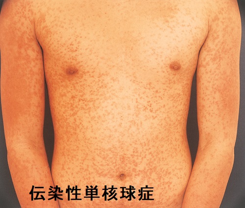 伝染性単核球症 伝染性単核球症