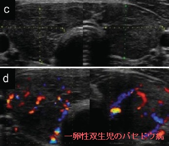 一卵性双生児のバセドウ病(姉妹B) 一卵性双生児のバセドウ病(姉妹B)