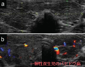 一卵性双生児のバセドウ病(姉妹A) 一卵性双生児のバセドウ病(姉妹A)