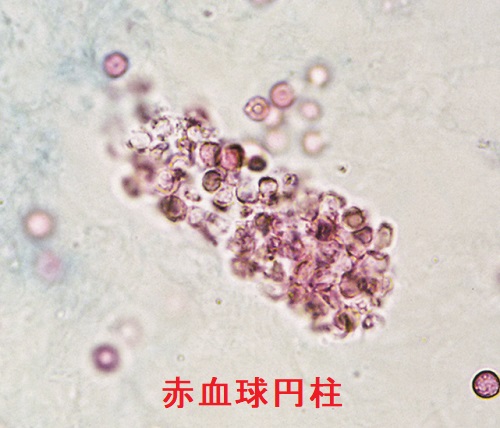 赤血球円柱 赤血球円柱