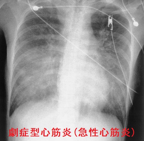 劇症型心筋炎 劇症型心筋炎
