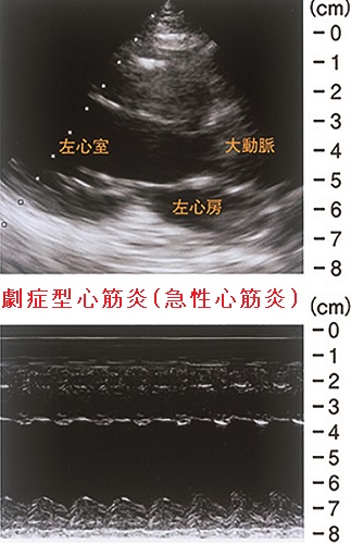 劇症型心筋炎 劇症型心筋炎