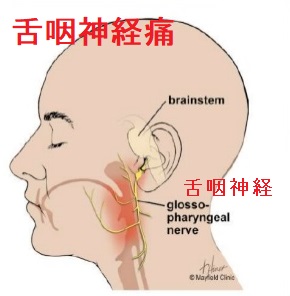 舌咽神経痛 舌咽神経痛