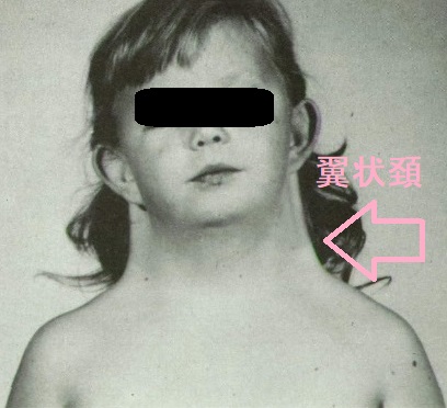 翼状頚 翼状頚