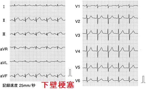 下壁梗塞 下壁梗塞