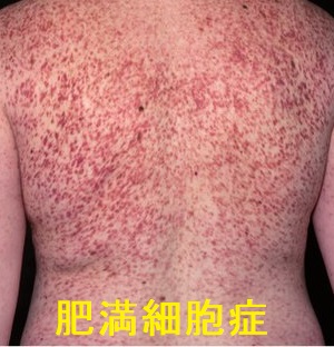 肥満細胞症 肥満細胞症